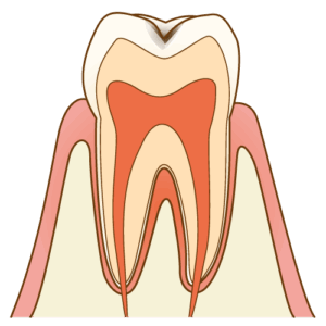 C0：ごく初期の虫歯
