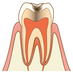 C2：象牙質に達するむし歯