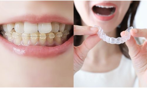 ワイヤー・マウスピース